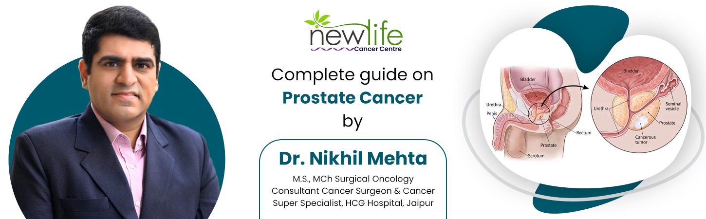 You are currently viewing Guide on Prostate Cancer