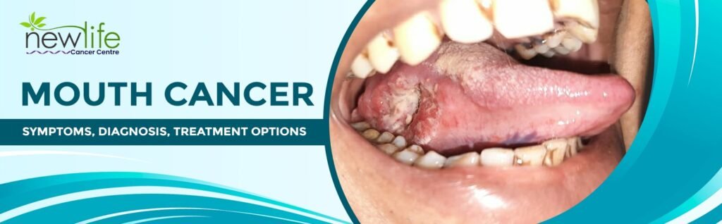 Person looking in the mirror checking mouth for sores or patches, symbolizing early detection of mouth cancer.
