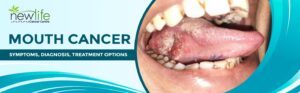 Read more about the article Living With Mouth Cancer: Recognizing Symptoms and Coping with Diagnosis