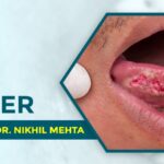Types of Oral Cancer: A Comprehensive Guide by Dr. Nikhil Mehta
