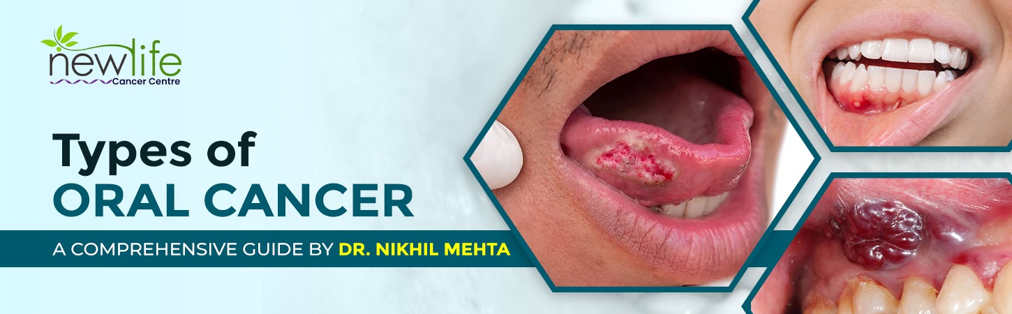 You are currently viewing Types of Oral Cancer: A Comprehensive Guide by Dr. Nikhil Mehta