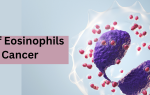 What Level of Eosinophils Indicate Cancer