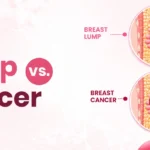 Difference Between Breast Lump vs Breast Cancer: How to Tell the Difference